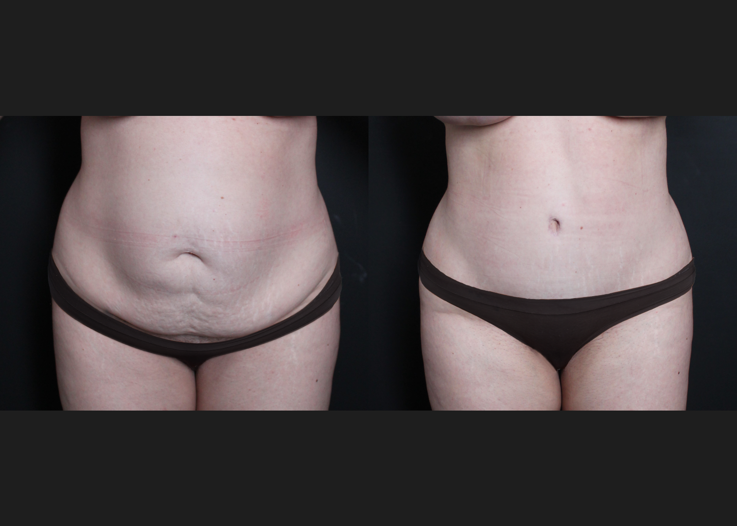 136400 Extended abdominoplasty before after- front