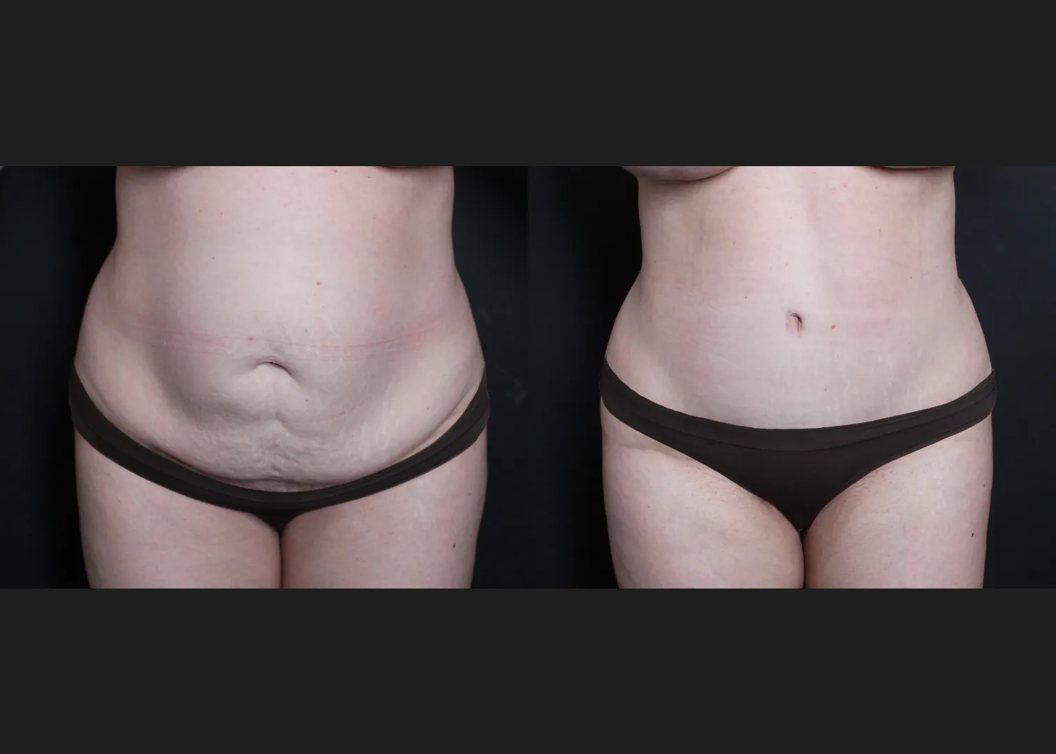 136400 Extended abdominoplasty before after- front