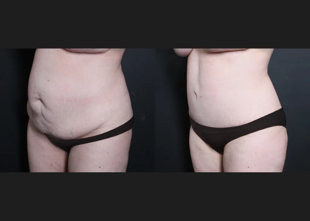Before and After photos of Dr. Zamani's patient highlighting the results of Mommy Makeover surgery in Beverly Hills.