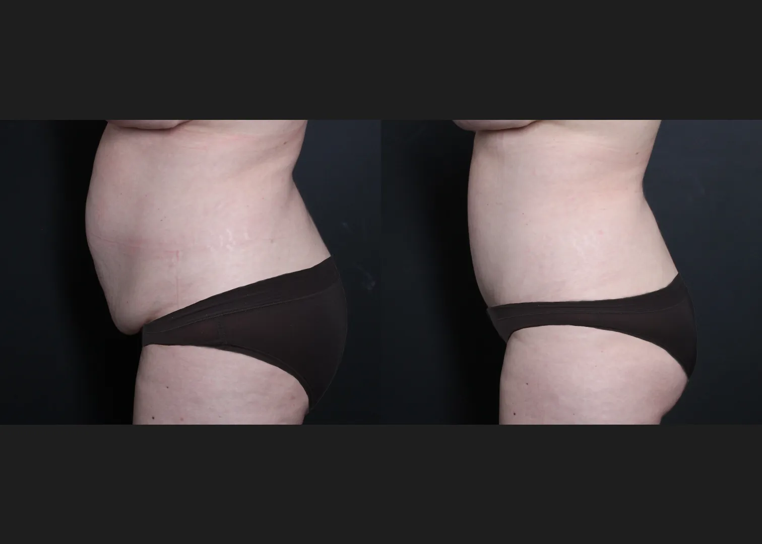 136400 Extended abdominoplasty before after- left