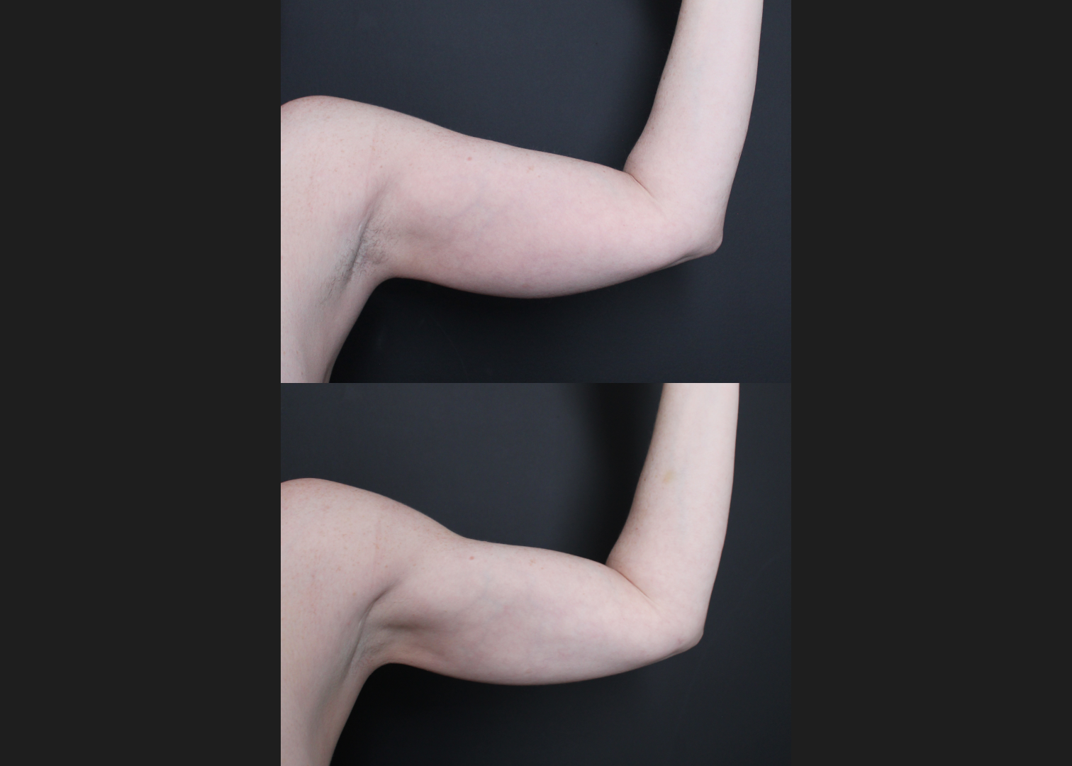 196414 Arm Lipo Renuvion Skin tIghtening Scarless Arm Lift female Before After – left ant