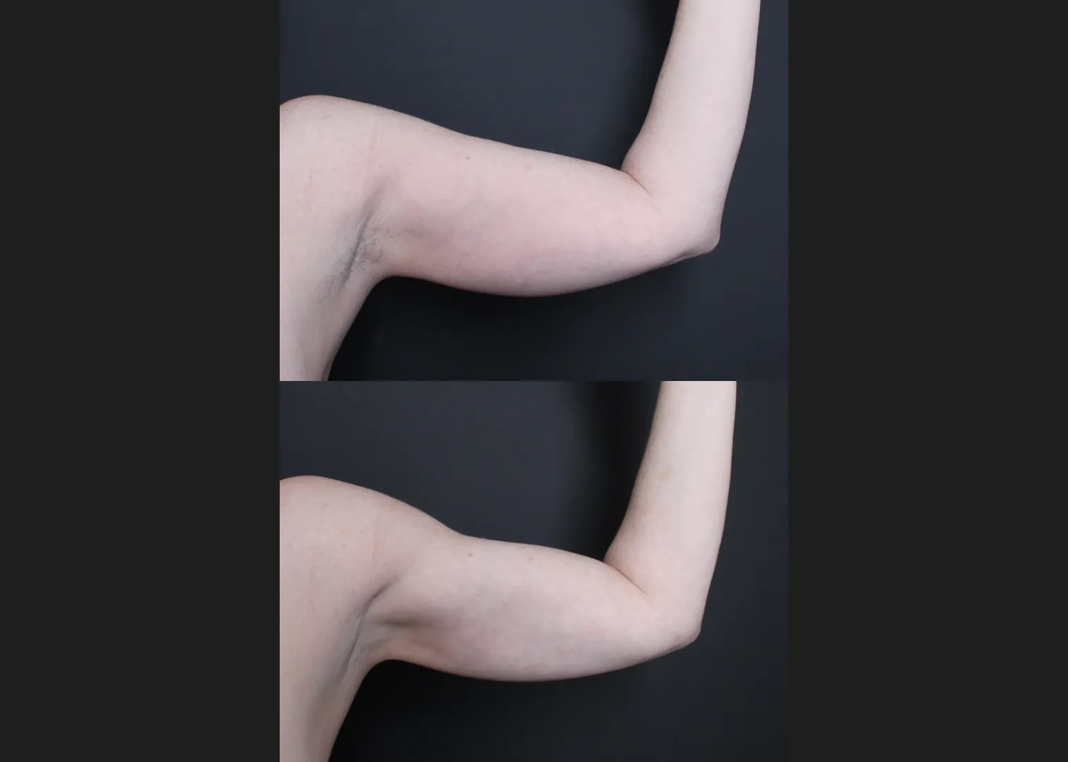 196414 Arm Lipo Renuvion Skin tIghtening Scarless Arm Lift female Before After – left ant