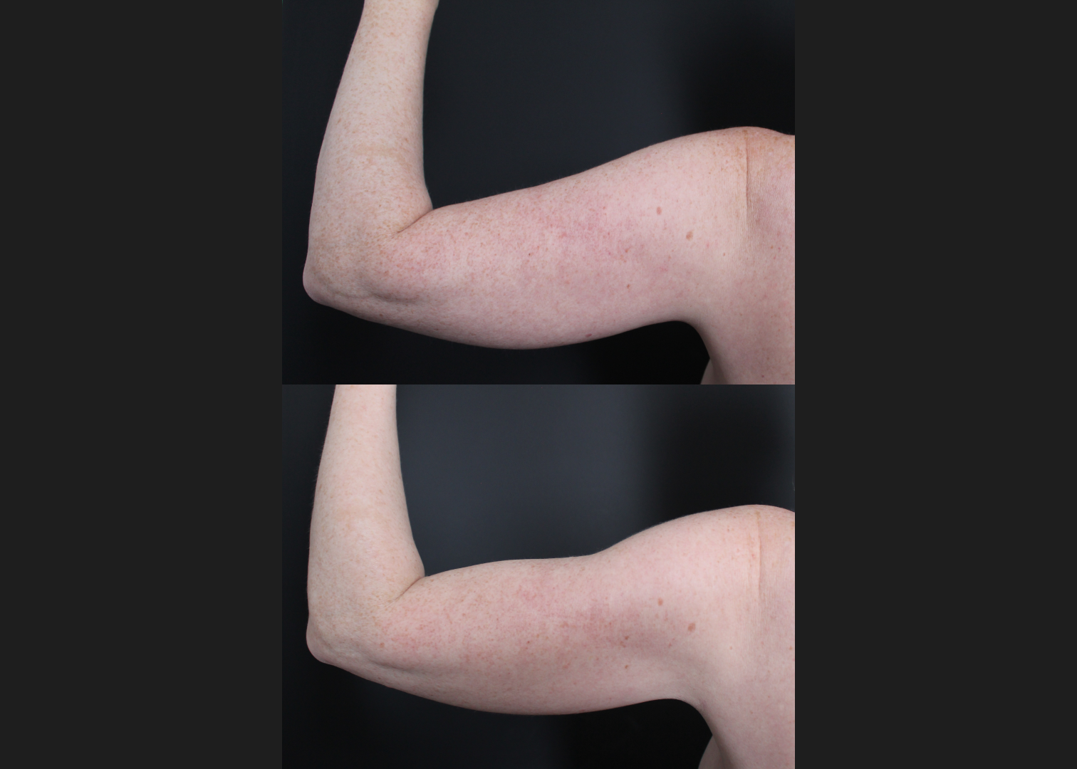 196414 Arm Lipo Renuvion Skin tIghtening Scarless Arm Lift female Before After – left post