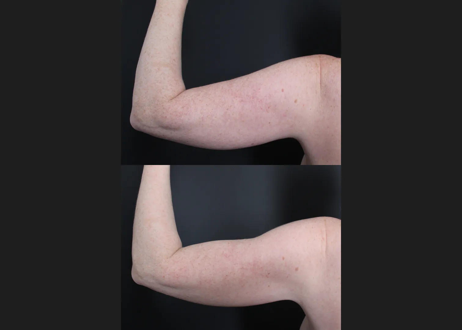 196414 Arm Lipo Renuvion Skin tIghtening Scarless Arm Lift female Before After – left post