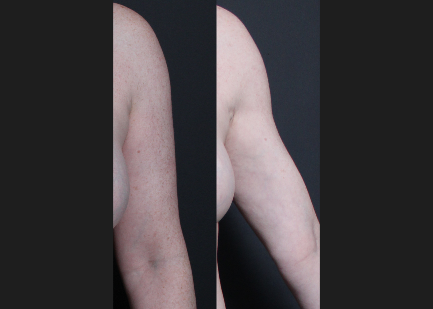 196414 Arm Lipo Renuvion Skin tIghtening Scarless Arm Lift female Before After – left