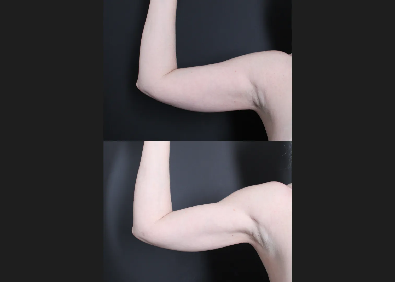 196414 Arm Lipo Renuvion Skin tIghtening Scarless Arm Lift female Before After- right ant