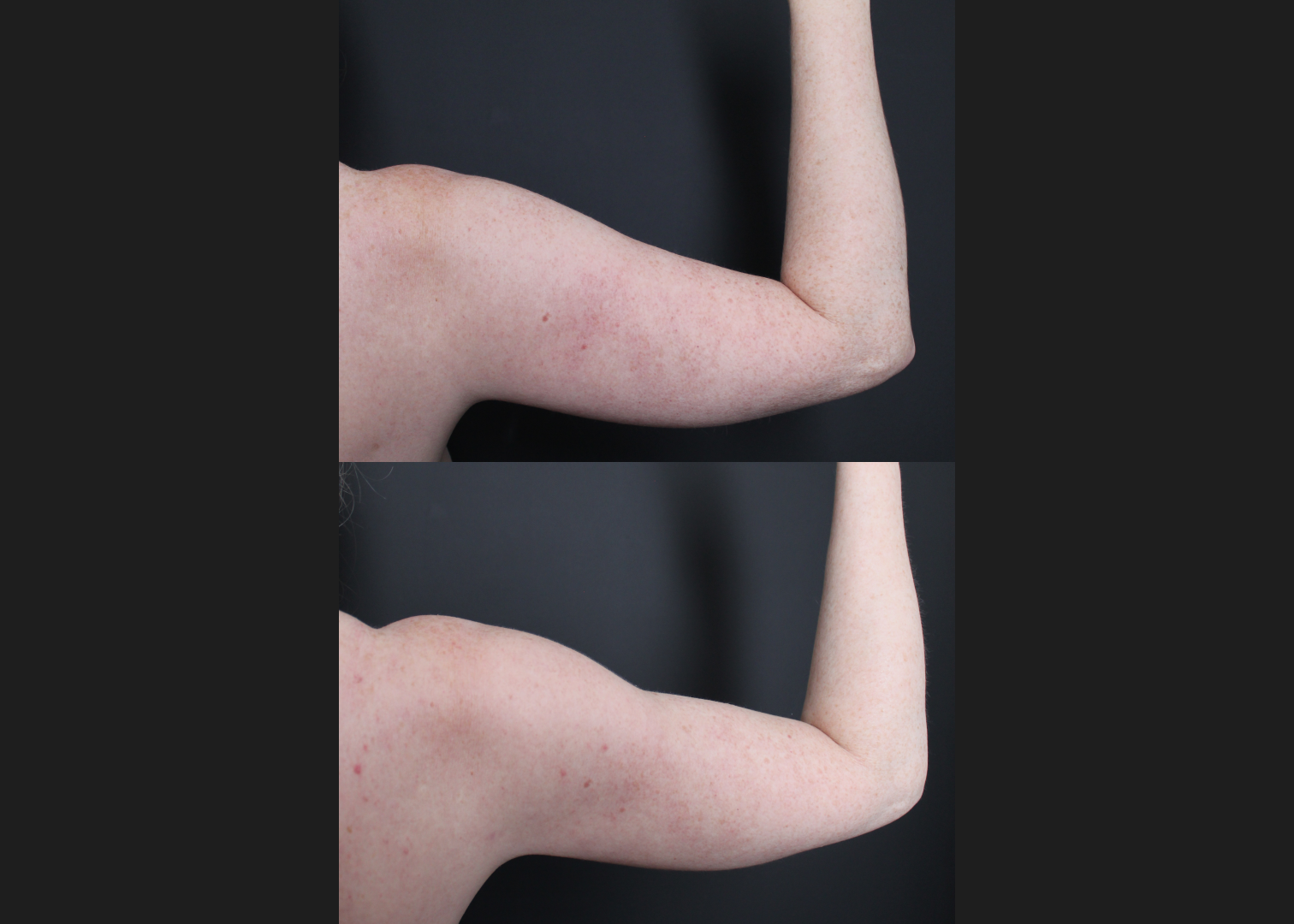 196414 Arm Lipo Renuvion Skin tIghtening Scarless Arm Lift female Before After- right post