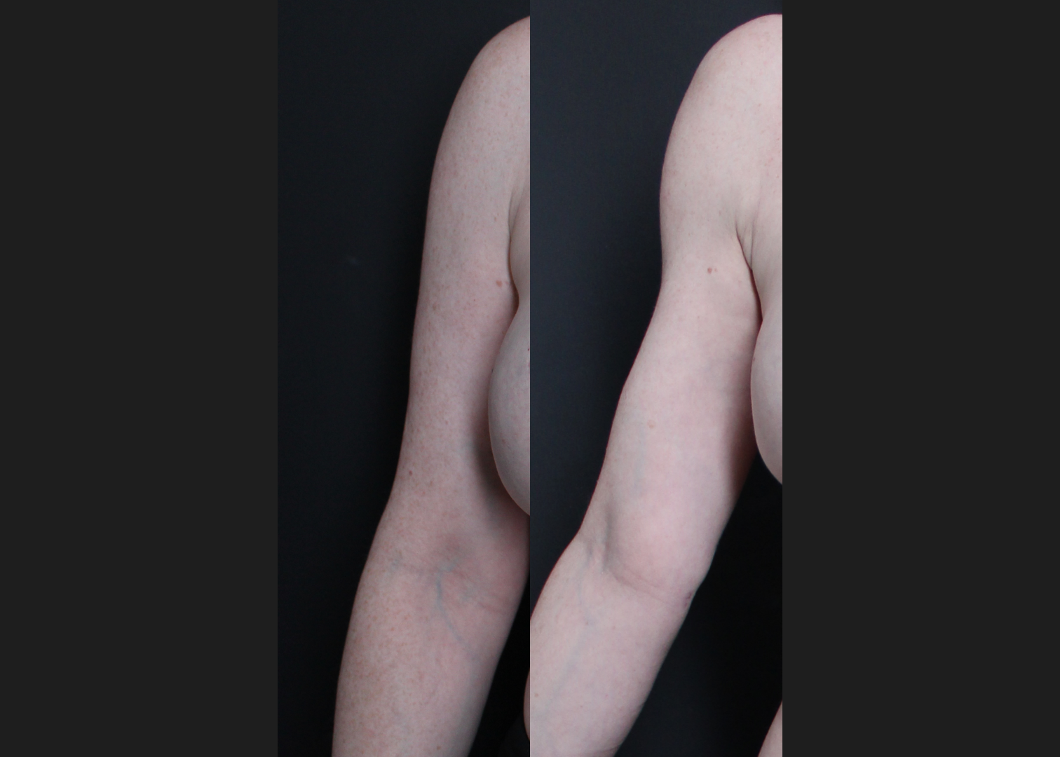 196414 Arm Lipo Renuvion Skin tIghtening Scarless Arm Lift female Before After – right