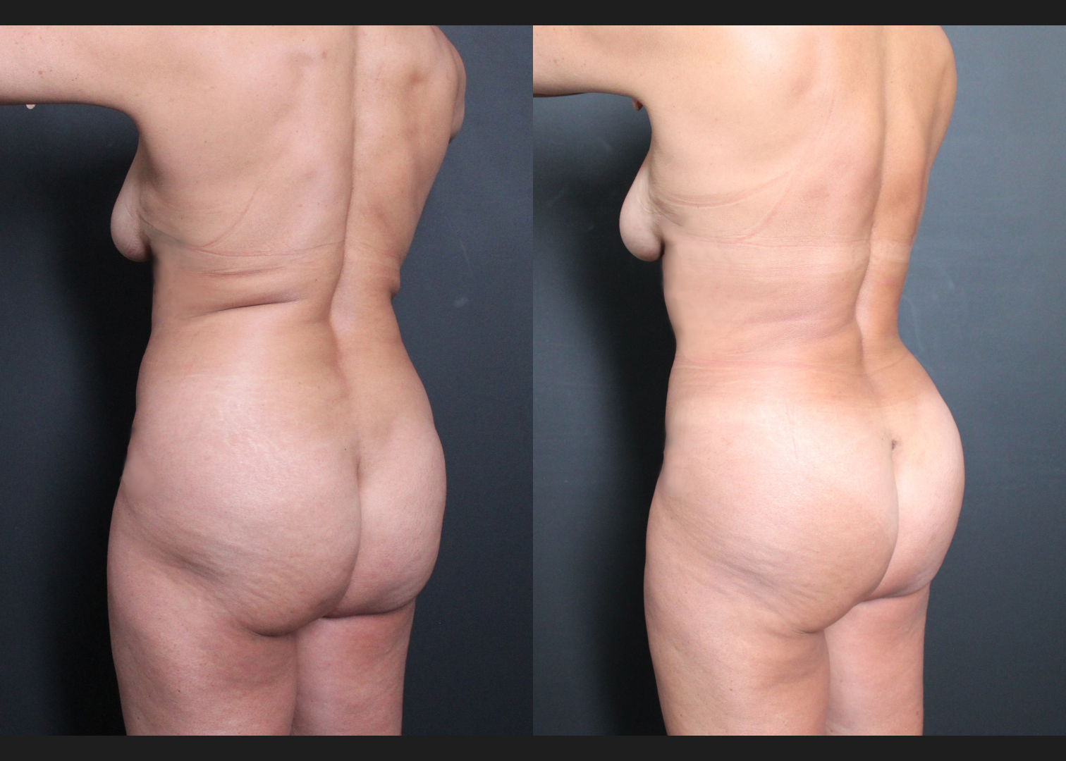 197100 Back Lipo Upper Back Renuvion Fat transfer to buttocks BBL before after- left oblique