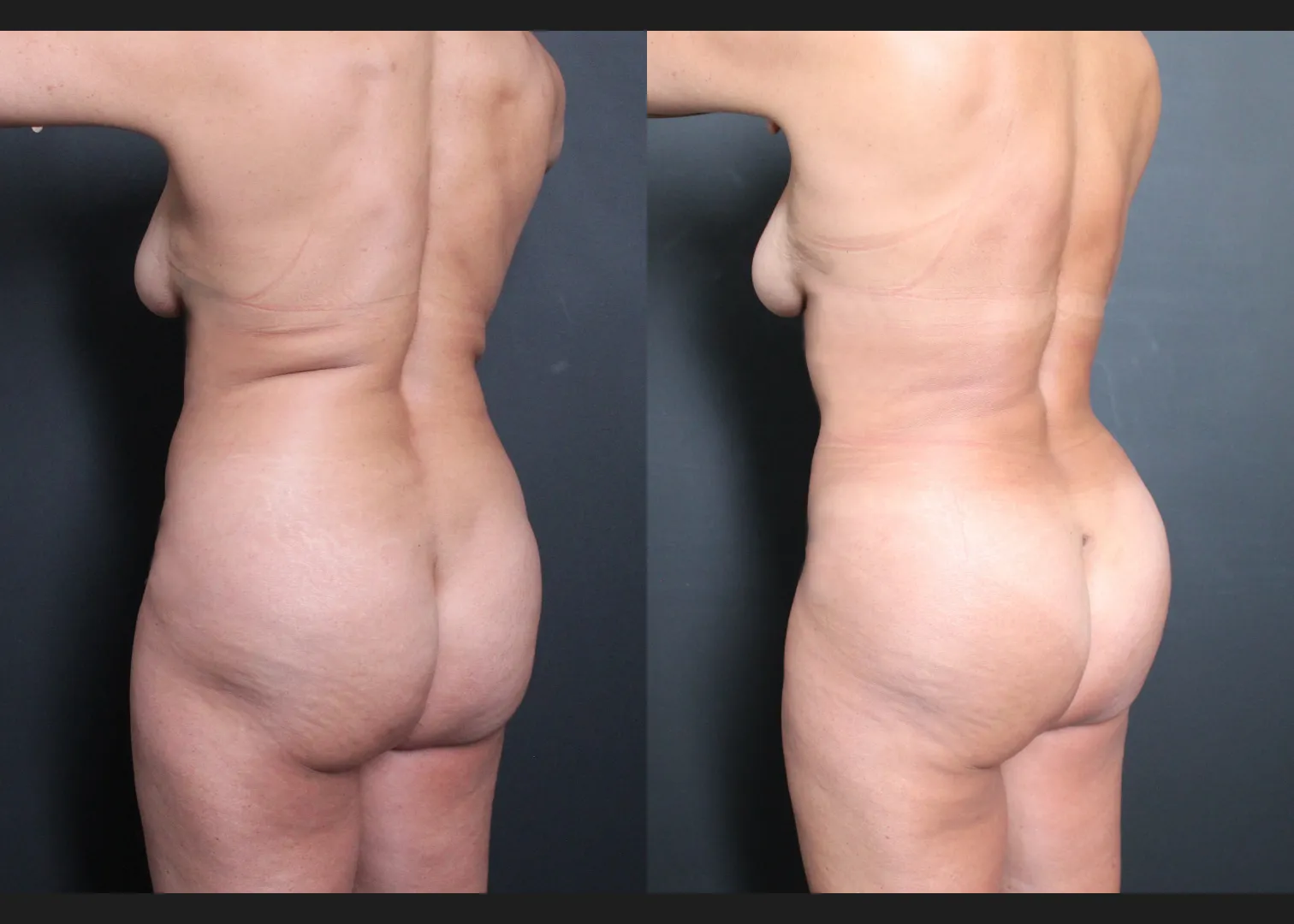 197100 Back Lipo Upper Back Renuvion Fat transfer to buttocks BBL before after- left oblique