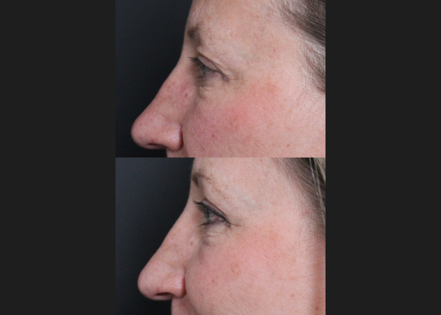 205261 upper blepharoplasty female before after 6 weeks left