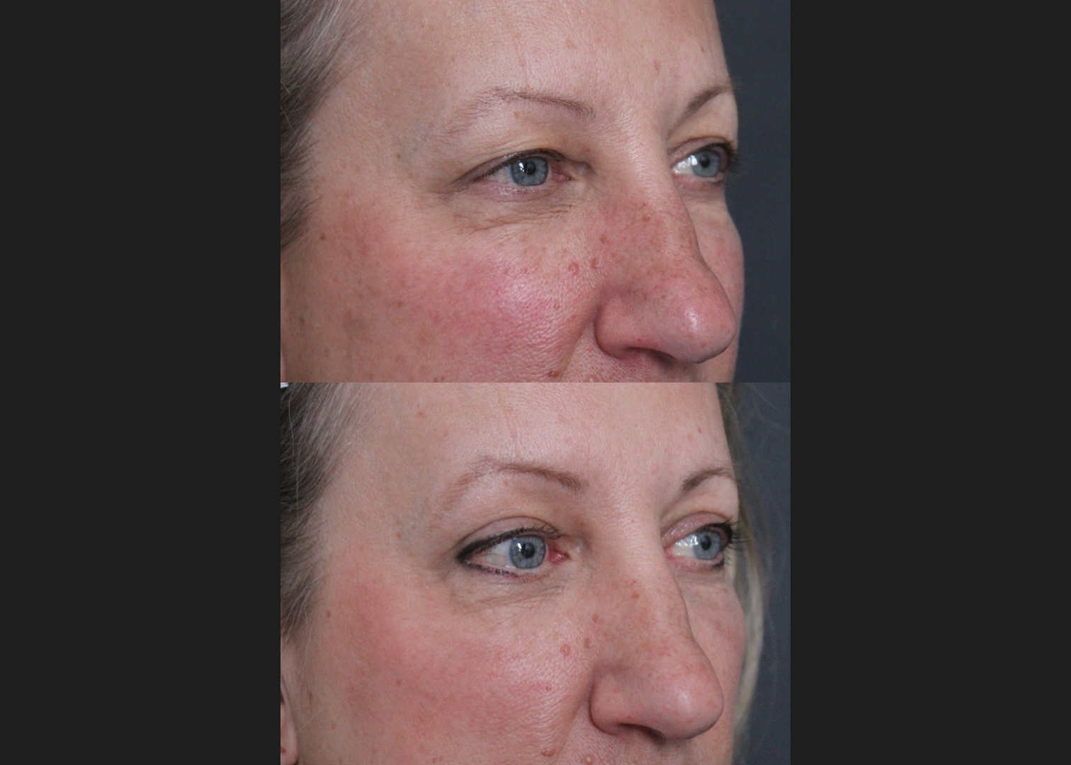 205261 upper blepharoplasty female before after 6 weeks oblique right