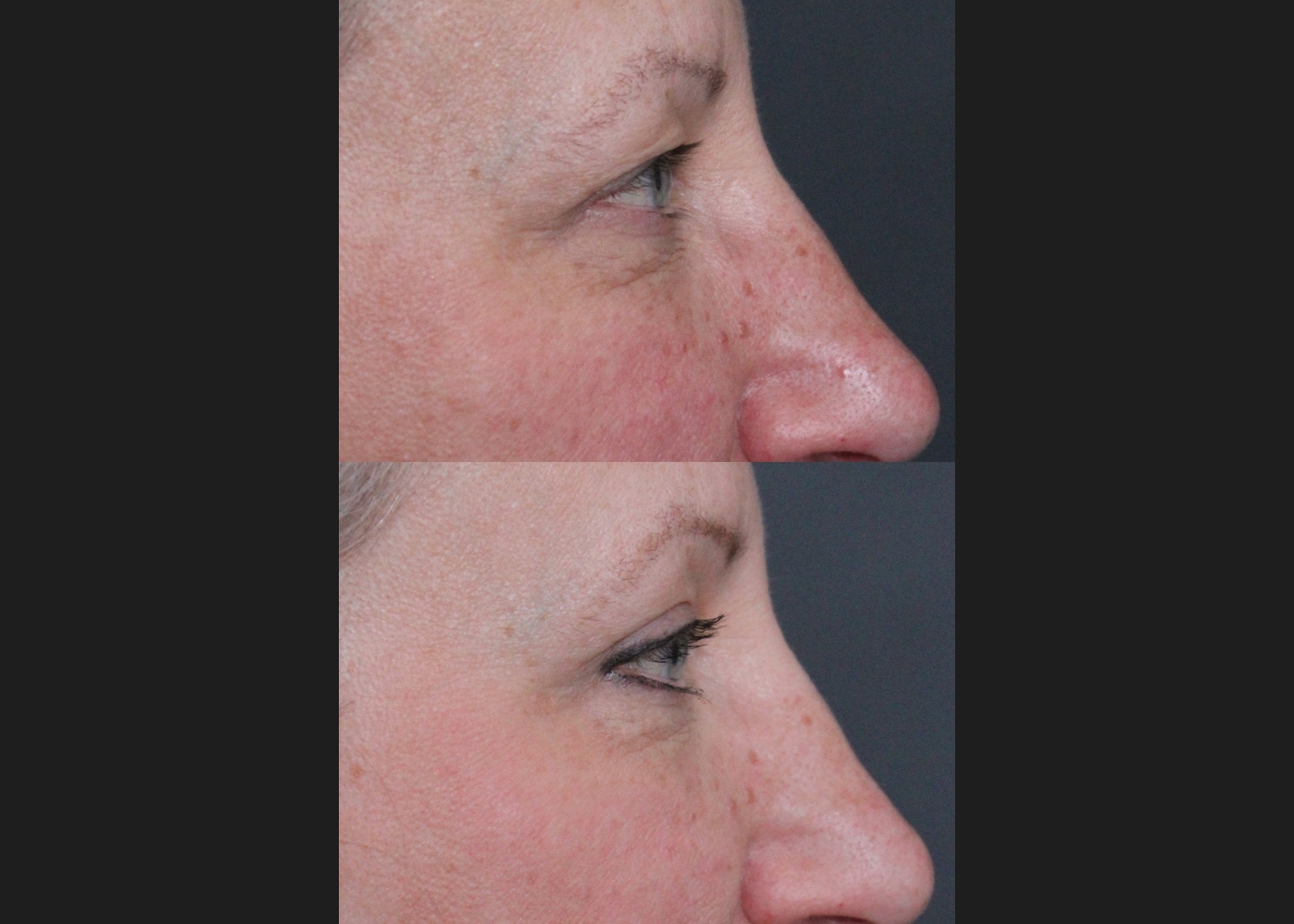 205261 upper blepharoplasty female before after 6 weeks right