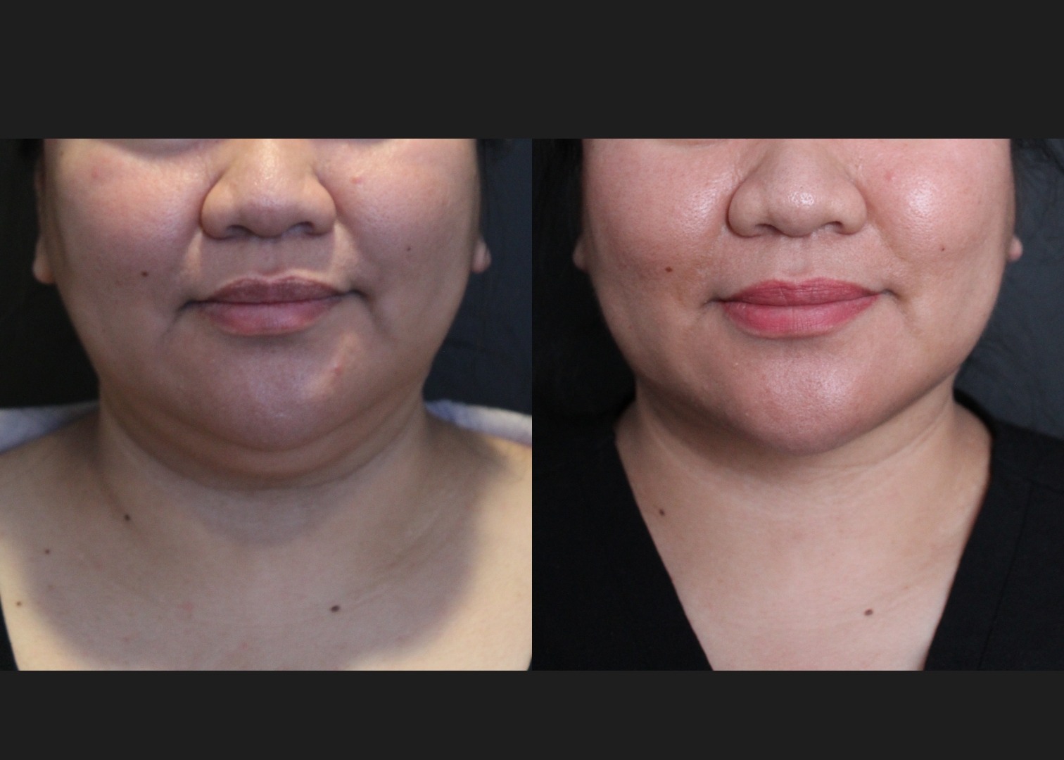 208318 submental neck vaser lipo before after – front