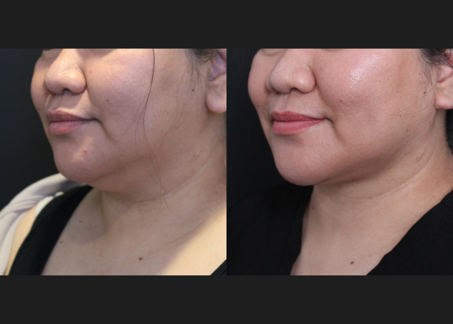 208318 submental neck vaser lipo before after – left oblique