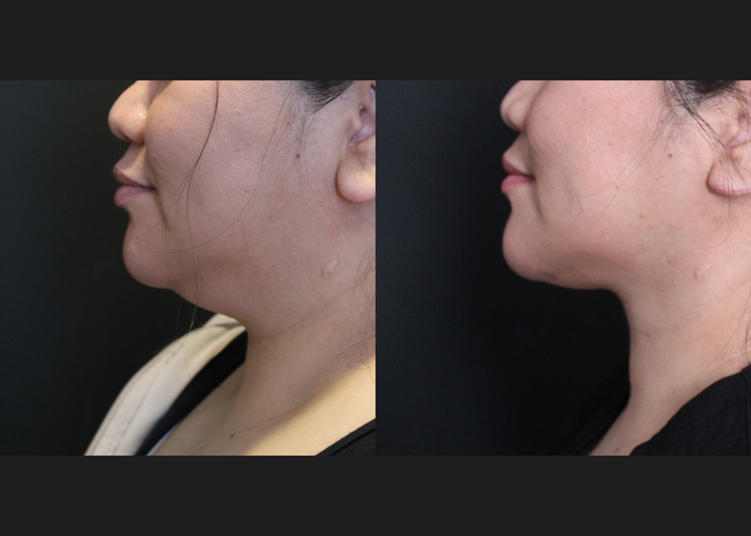 208318 submental neck vaser lipo before after – left