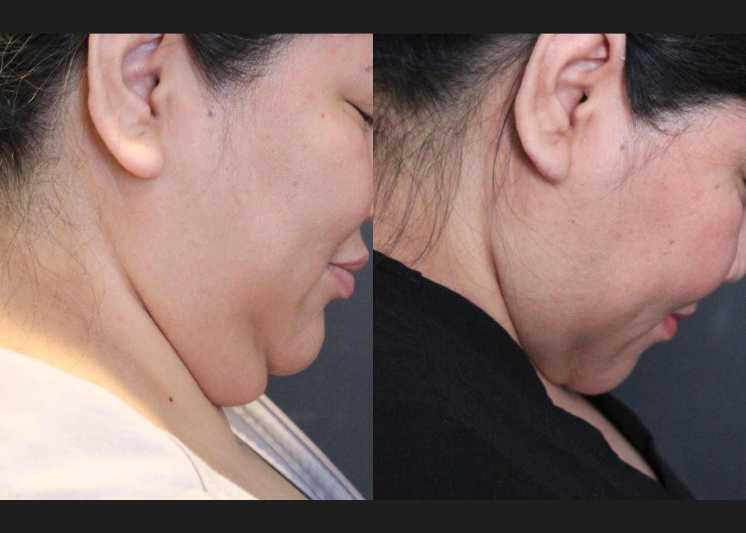 208318 submental neck vaser lipo before after – right down