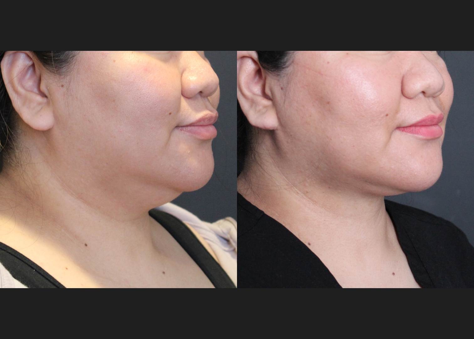 208318 submental neck vaser lipo before after – right oblique