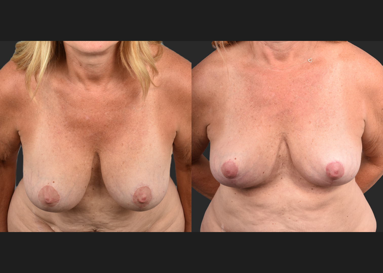 2135189 Breast Implant Illness BII Implant Removal Revision Auto-Augmentation Mastopexy Lift Fat transfer to Breasts Before After- Cleavage