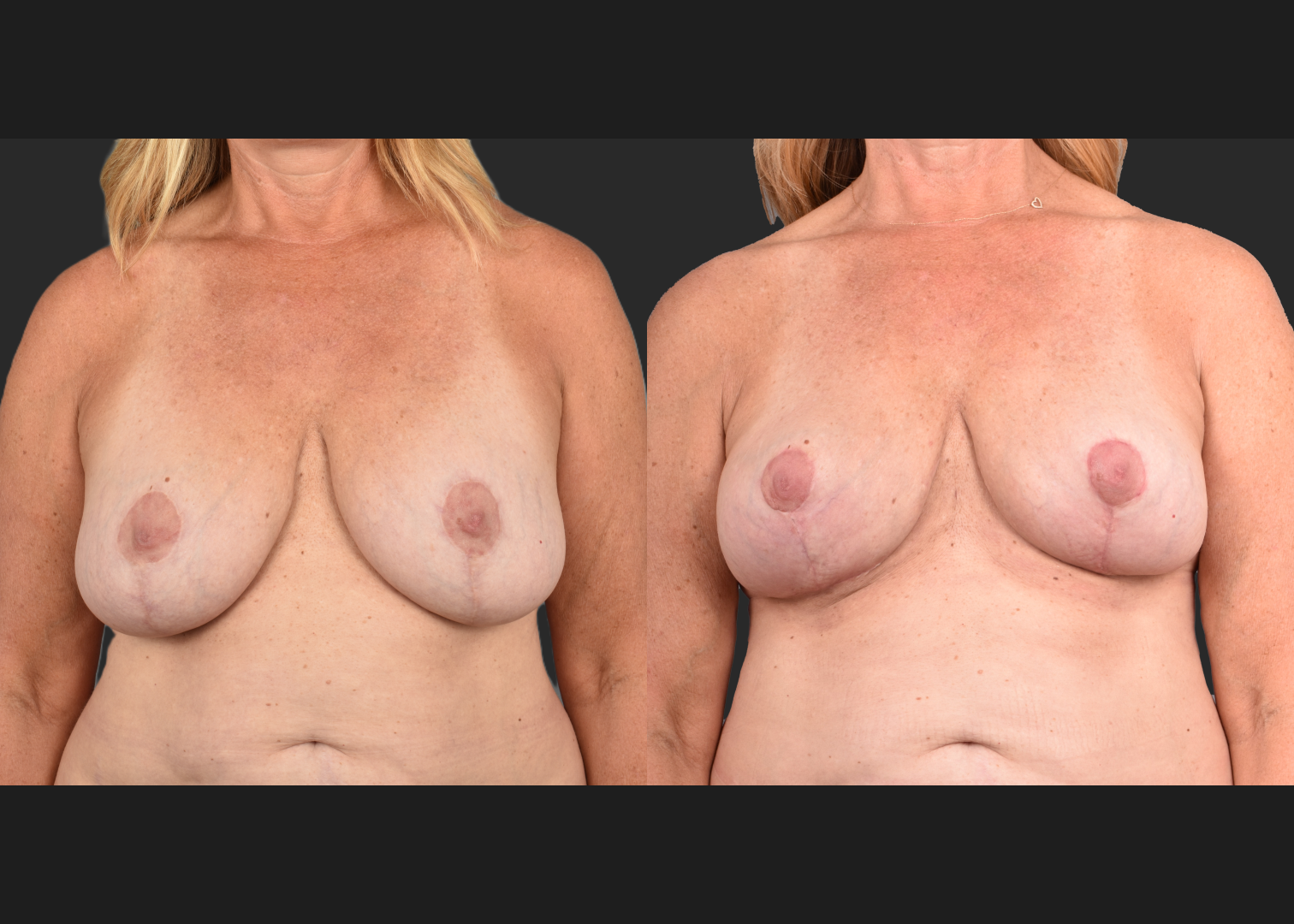 2135189 Breast Implant Illness BII Implant Removal Revision Auto-Augmentation Mastopexy Lift Fat transfer to Breasts Before After- Front 2