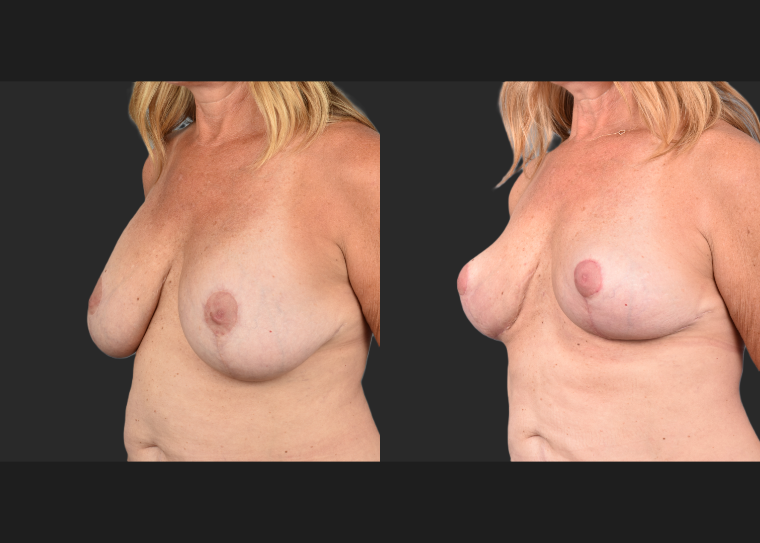 2135189 Breast Implant Illness BII Implant Removal Revision Auto-Augmentation Mastopexy Lift Fat transfer to Breasts Before After- left oblique