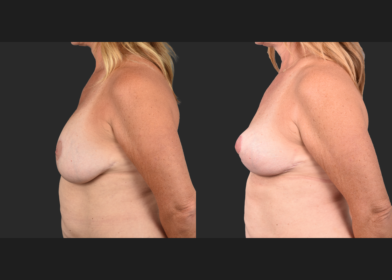 2135189 Breast Implant Illness BII Implant Removal Revision Auto-Augmentation Mastopexy Lift Fat transfer to Breasts Before After- left