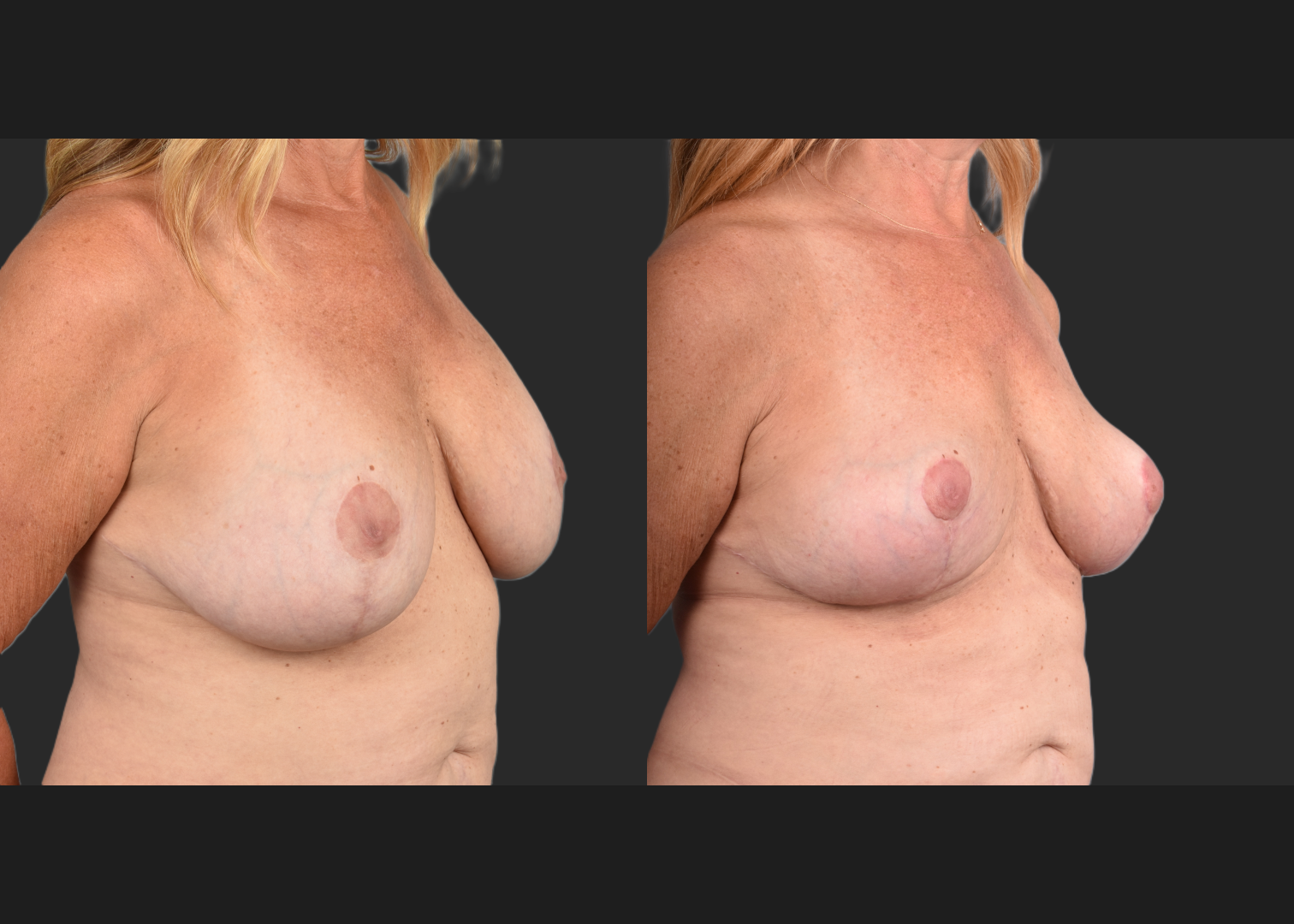 2135189 Breast Implant Illness BII Implant Removal Revision Auto-Augmentation Mastopexy Lift Fat transfer to Breasts Before After- right oblique