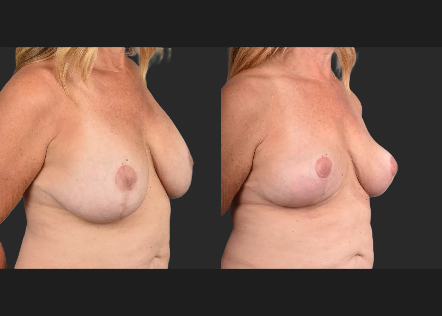 2135189 Breast Implant Illness BII Implant Removal Revision Auto-Augmentation Mastopexy Lift Fat transfer to Breasts Before After- right oblique