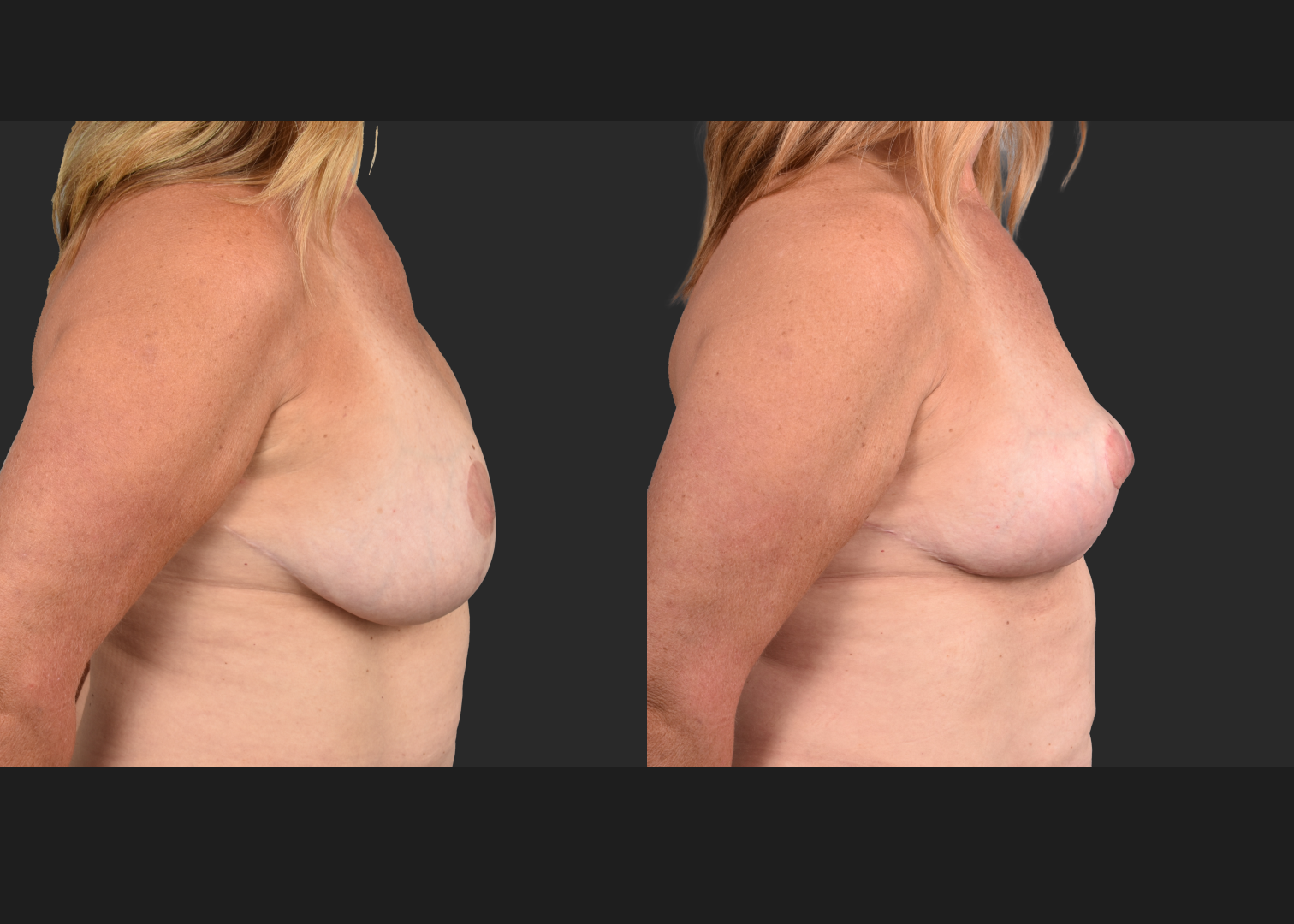 2135189 Breast Implant Illness BII Implant Removal Revision Auto-Augmentation Mastopexy Lift Fat transfer to Breasts Before After- right