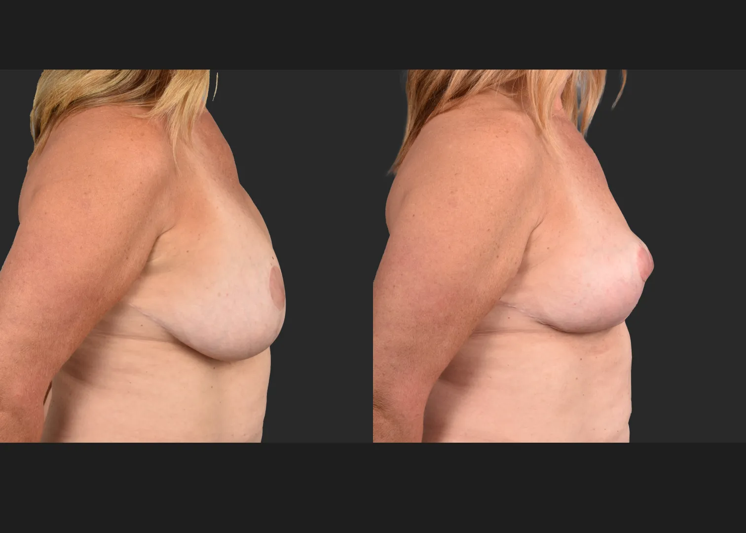 2135189 Breast Implant Illness BII Implant Removal Revision Auto-Augmentation Mastopexy Lift Fat transfer to Breasts Before After- right