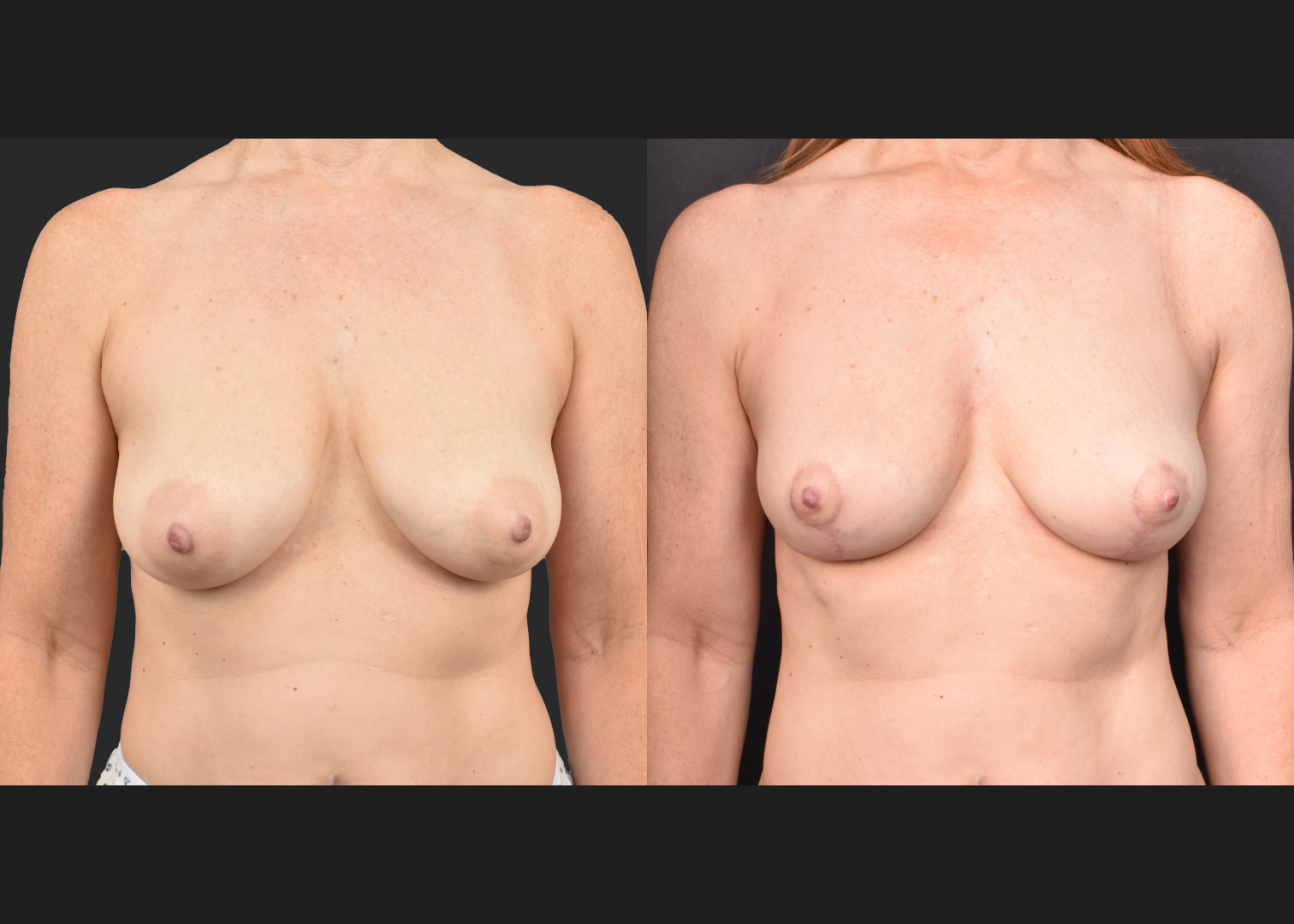 2135631 small breast reduction mastopexy lift fat transfer to breasts nipple reduction tuck before after- front