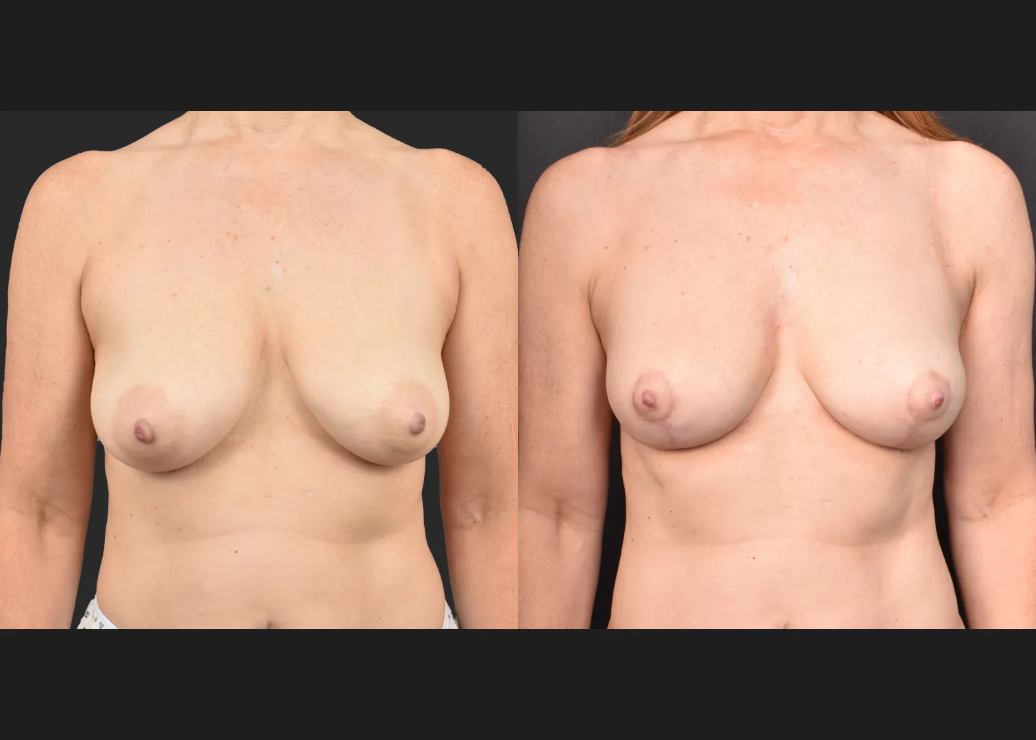 2135631 small breast reduction mastopexy lift fat transfer to breasts nipple reduction tuck before after- front