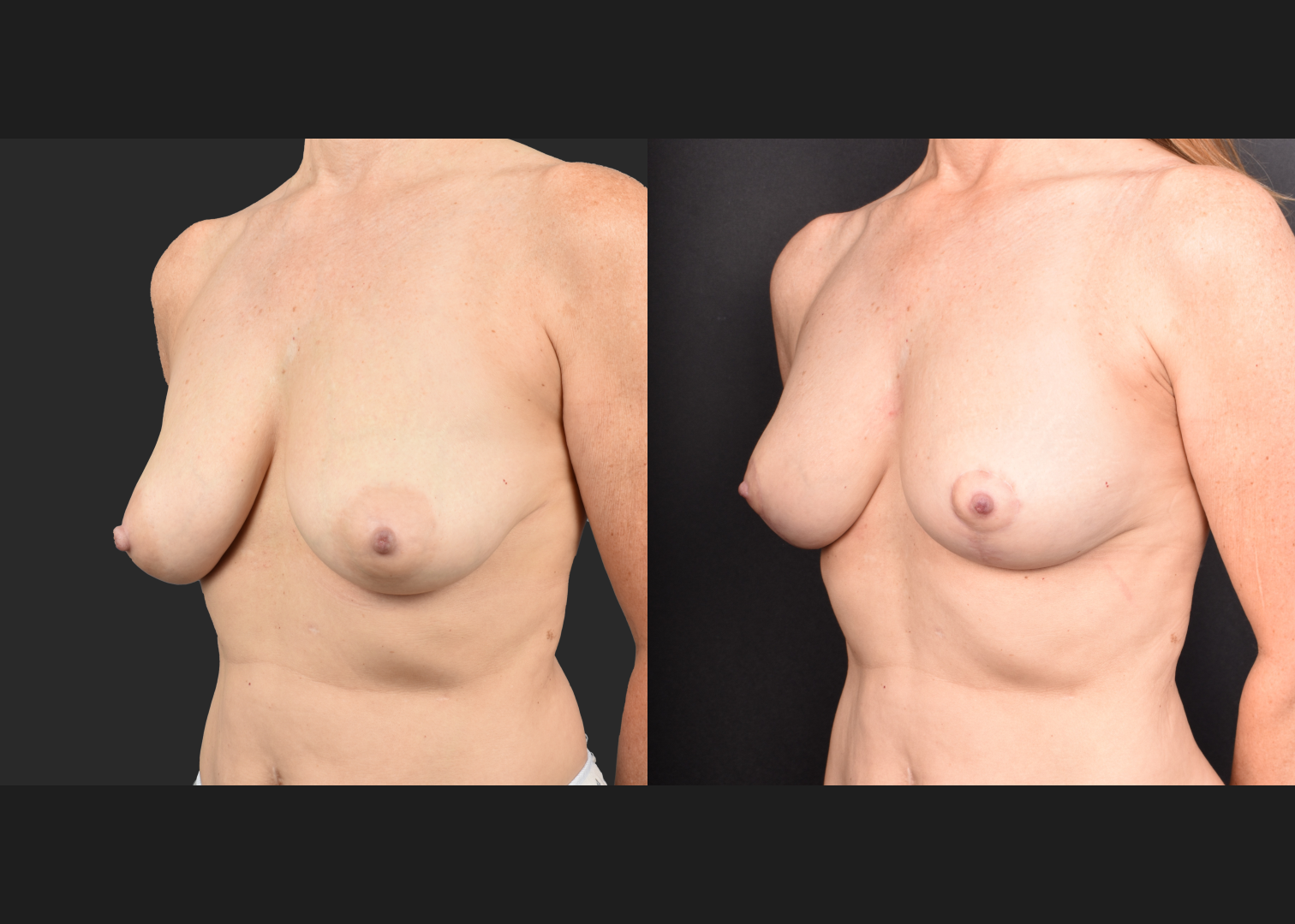 2135631 small breast reduction mastopexy lift fat transfer to breasts nipple reduction tuck before after- left oblique