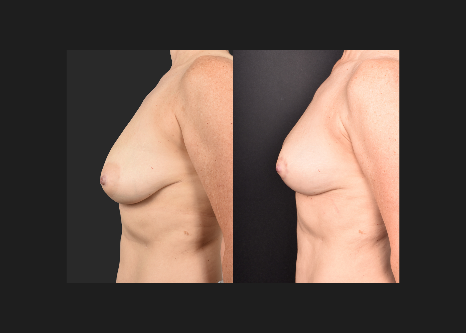 2135631 small breast reduction mastopexy lift fat transfer to breasts nipple reduction tuck before after- left