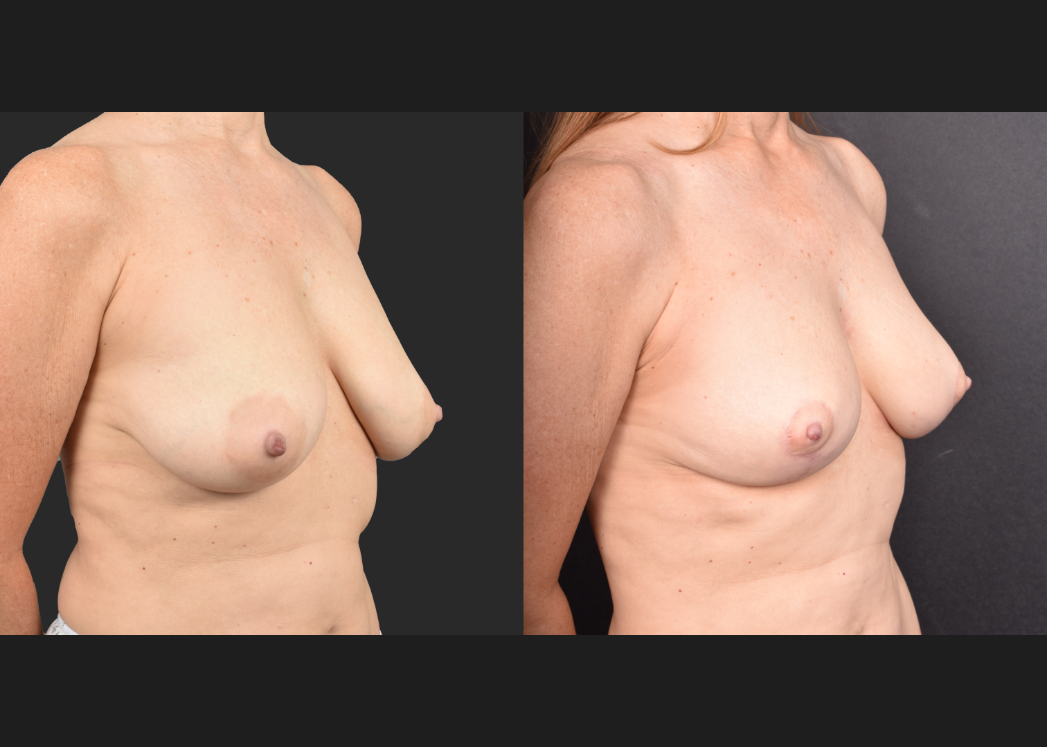 2135631 small breast reduction mastopexy lift fat transfer to breasts nipple reduction tuck before after- right oblique