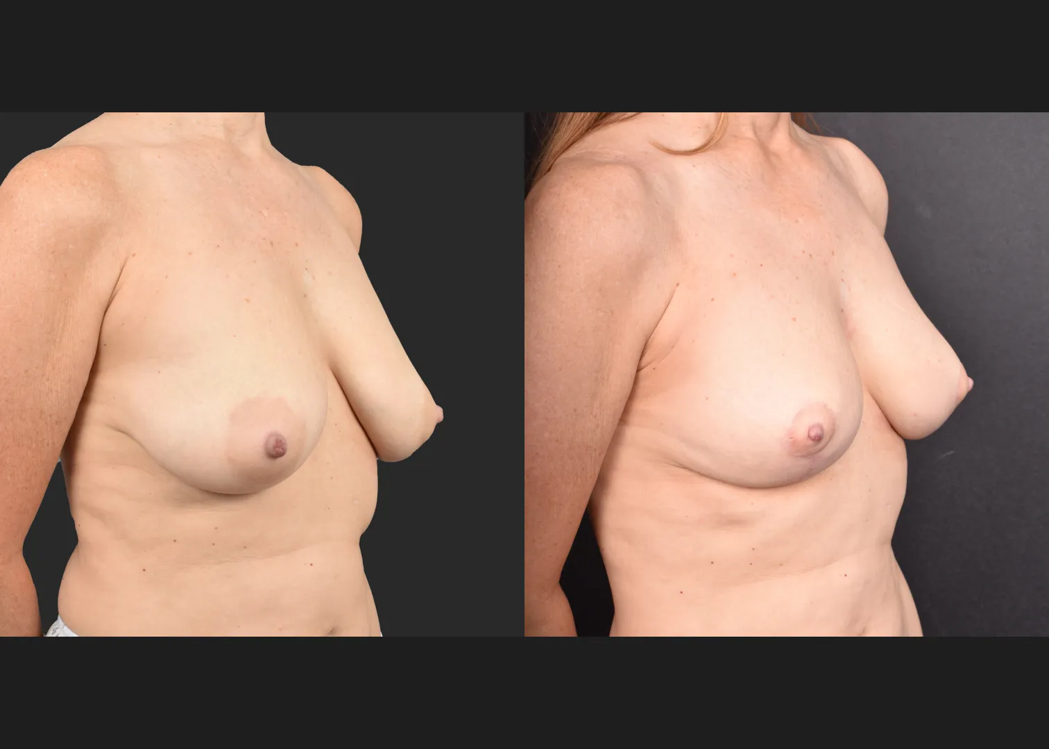 2135631 small breast reduction mastopexy lift fat transfer to breasts nipple reduction tuck before after- right oblique