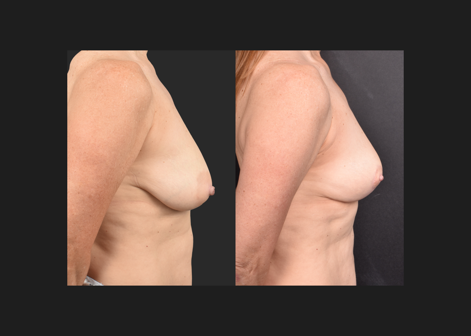 2135631 small breast reduction mastopexy lift fat transfer to breasts nipple reduction tuck before after- right