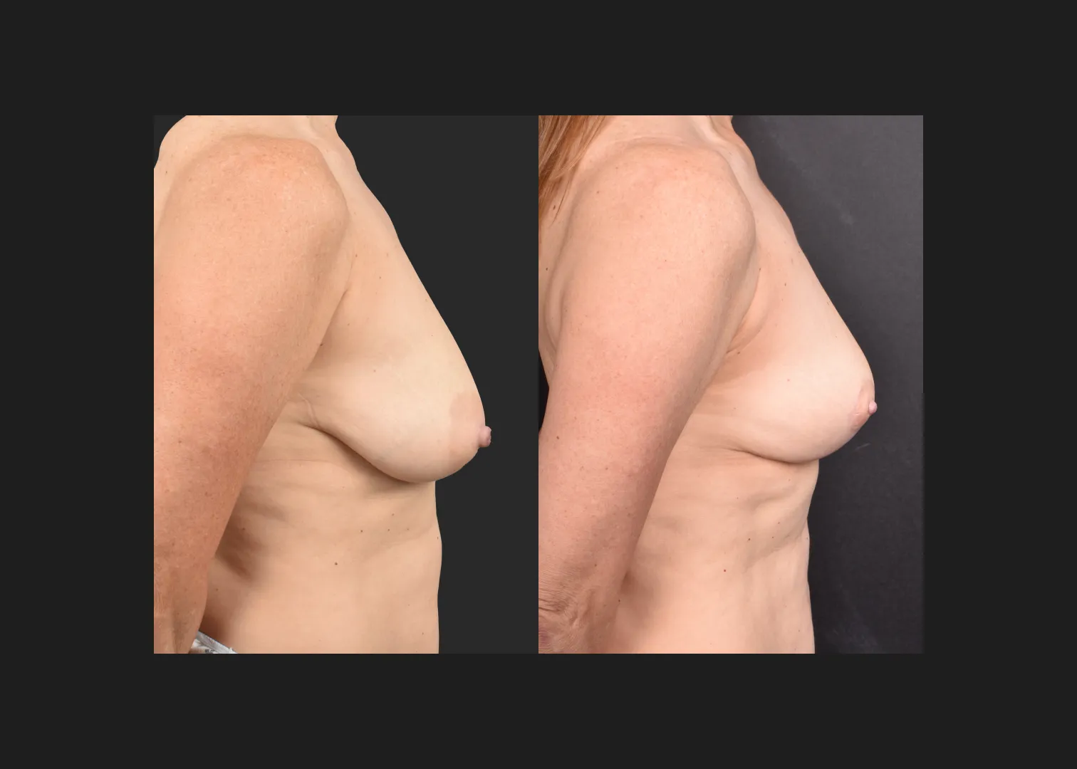 2135631 small breast reduction mastopexy lift fat transfer to breasts nipple reduction tuck before after- right
