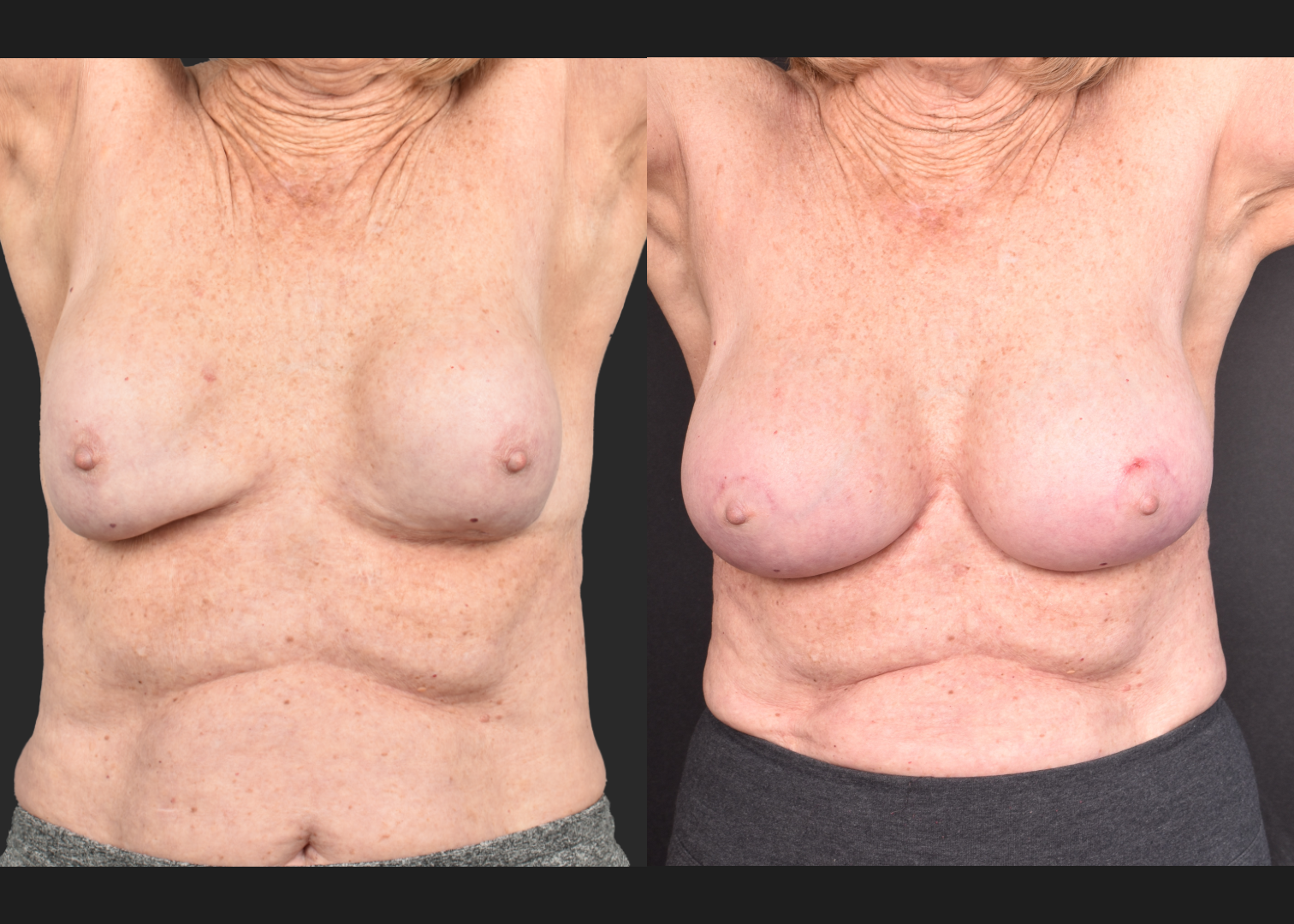 2140594 Breast implant revision exchange capsular contracture capsulectomy before after- arm up