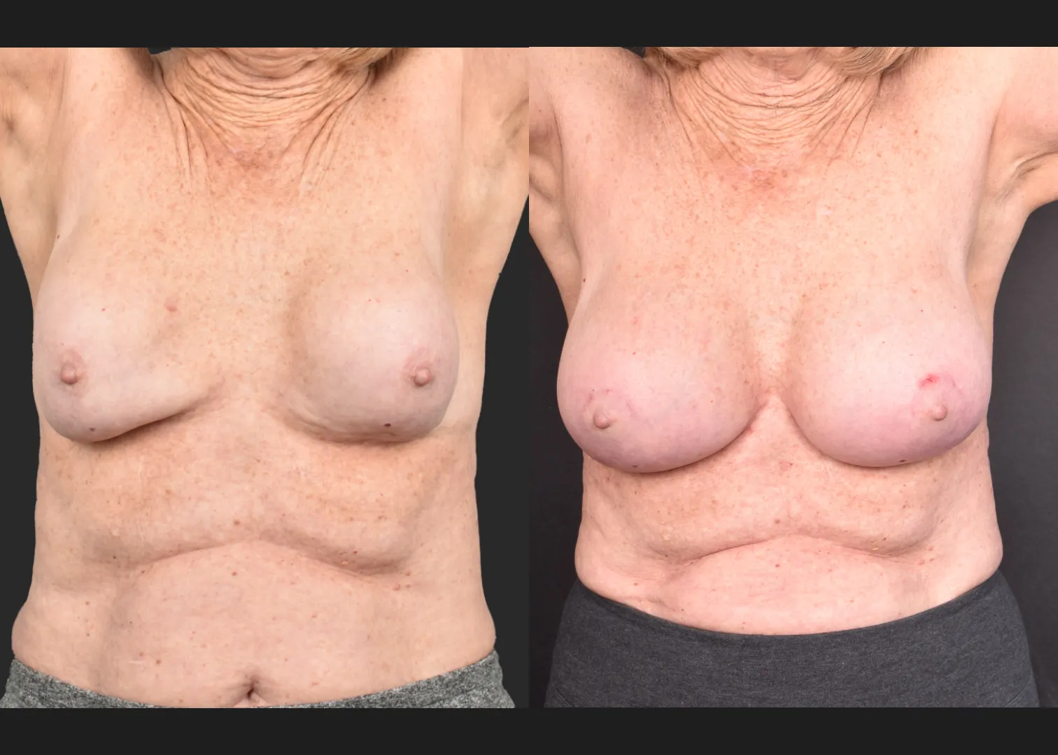 2140594 Breast implant revision exchange capsular contracture capsulectomy before after- arm up