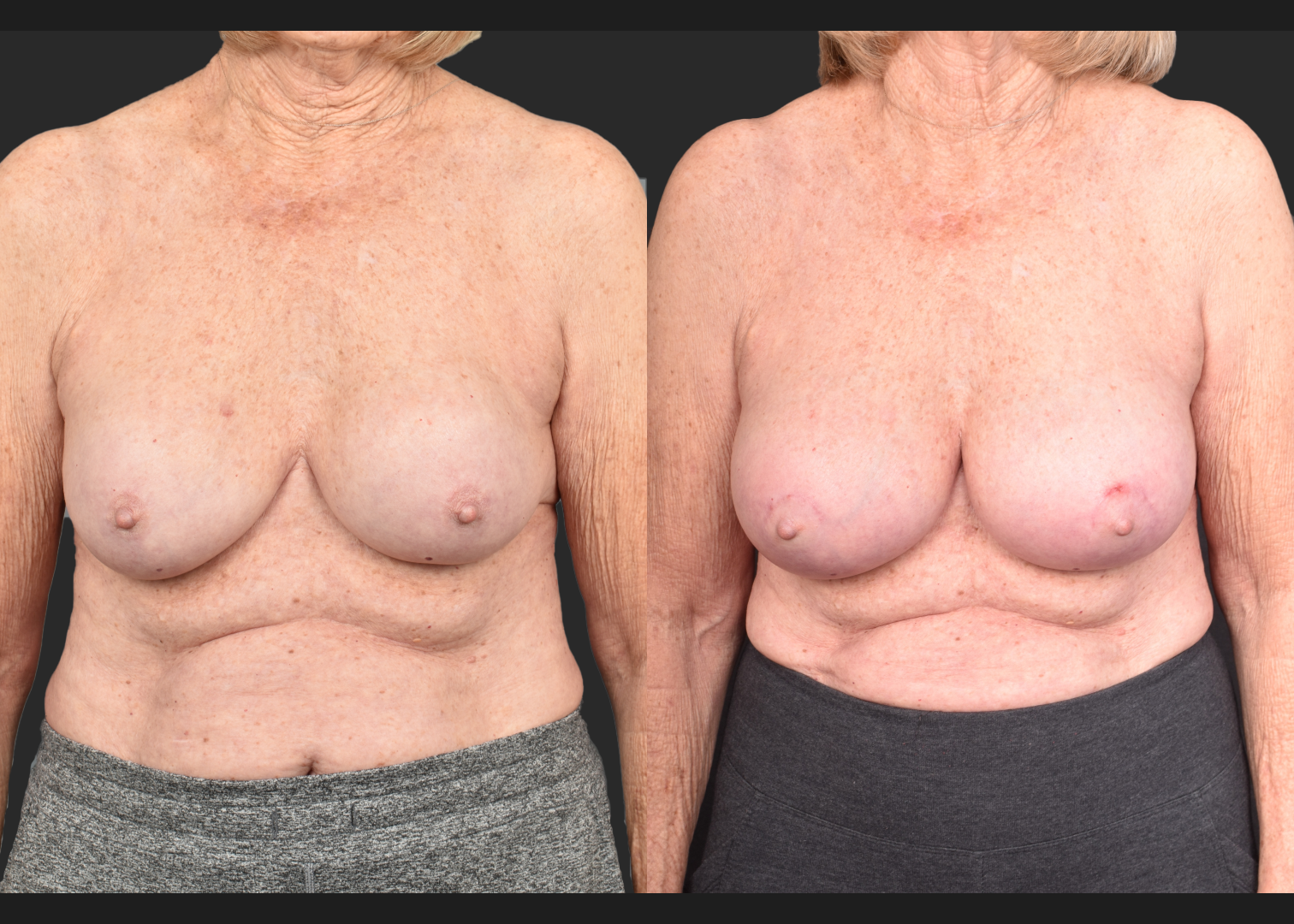 2140594 Breast implant revision exchange capsular contracture capsulectomy before after- front