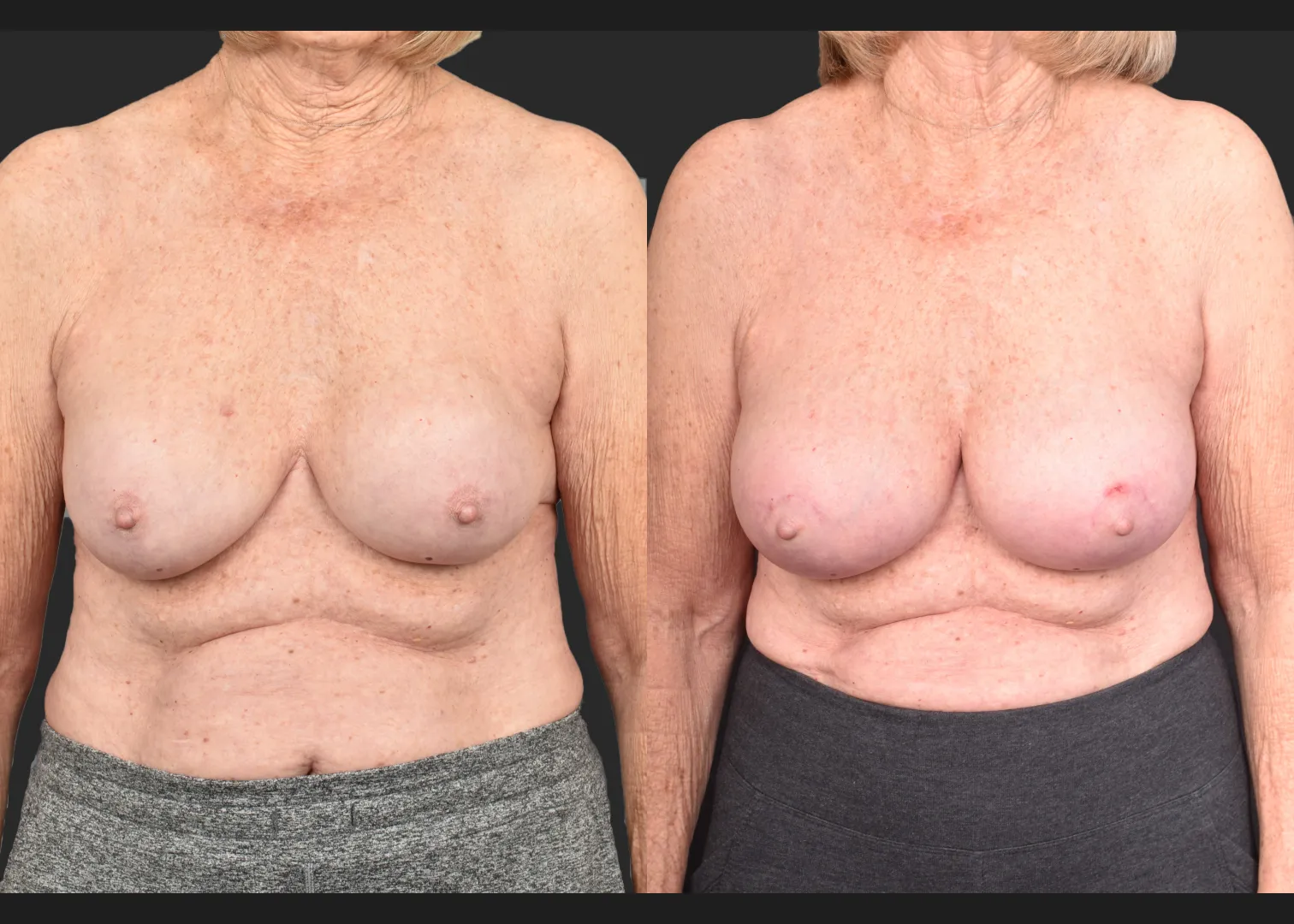 2140594 Breast implant revision exchange capsular contracture capsulectomy before after- front