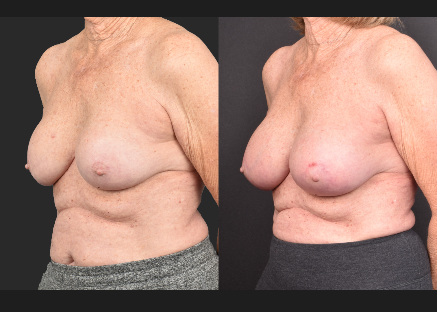 2140594 Breast implant revision exchange capsular contracture capsulectomy before after- left oblique