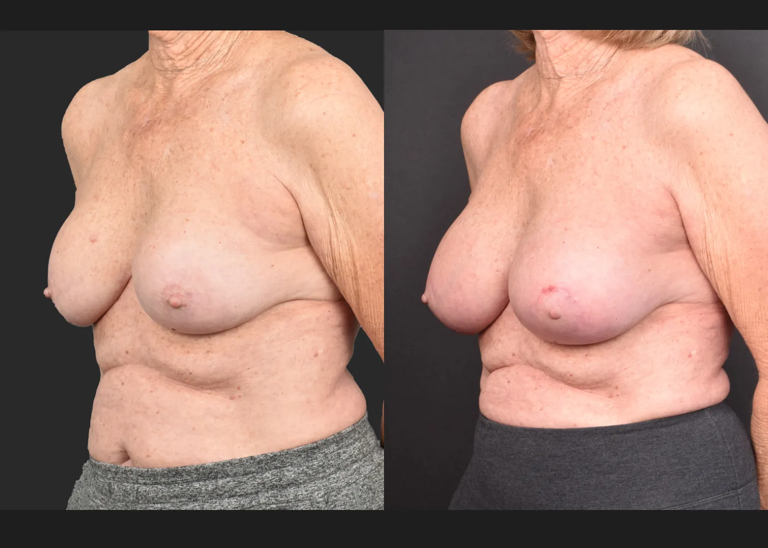 2140594 Breast implant revision exchange capsular contracture capsulectomy before after- left oblique