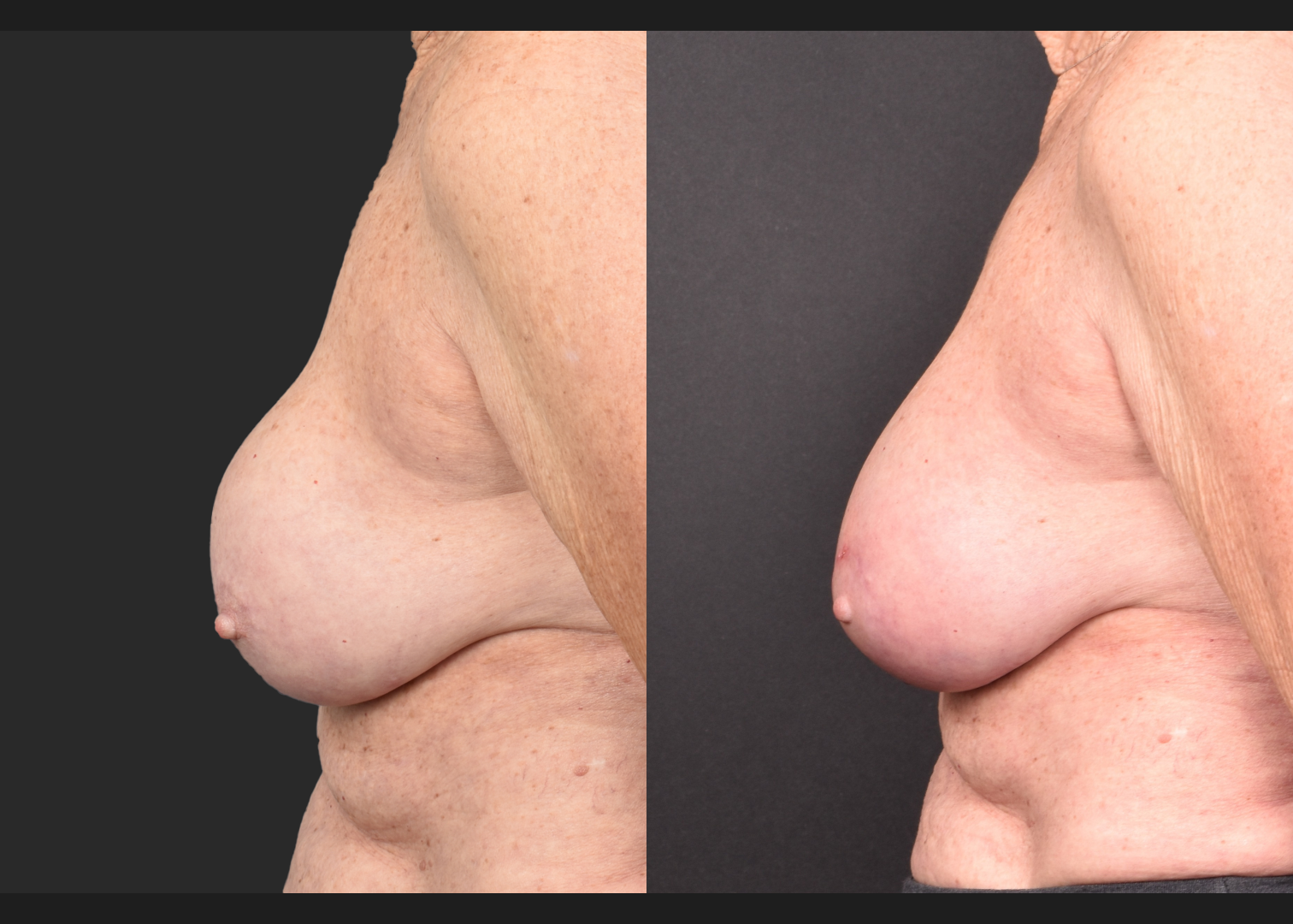 2140594 Breast implant revision exchange capsular contracture capsulectomy before after- left