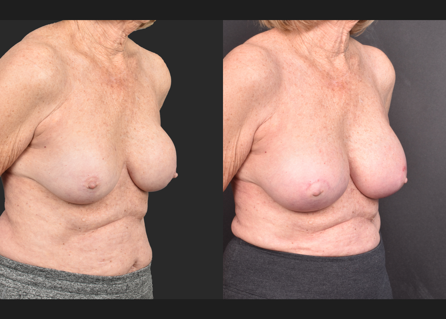 2140594 Breast implant revision exchange capsular contracture capsulectomy before after- right oblique