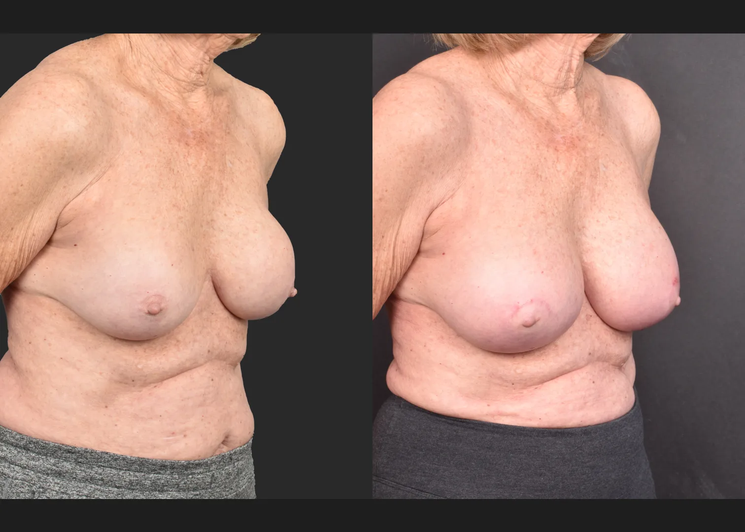 2140594 Breast implant revision exchange capsular contracture capsulectomy before after- right oblique