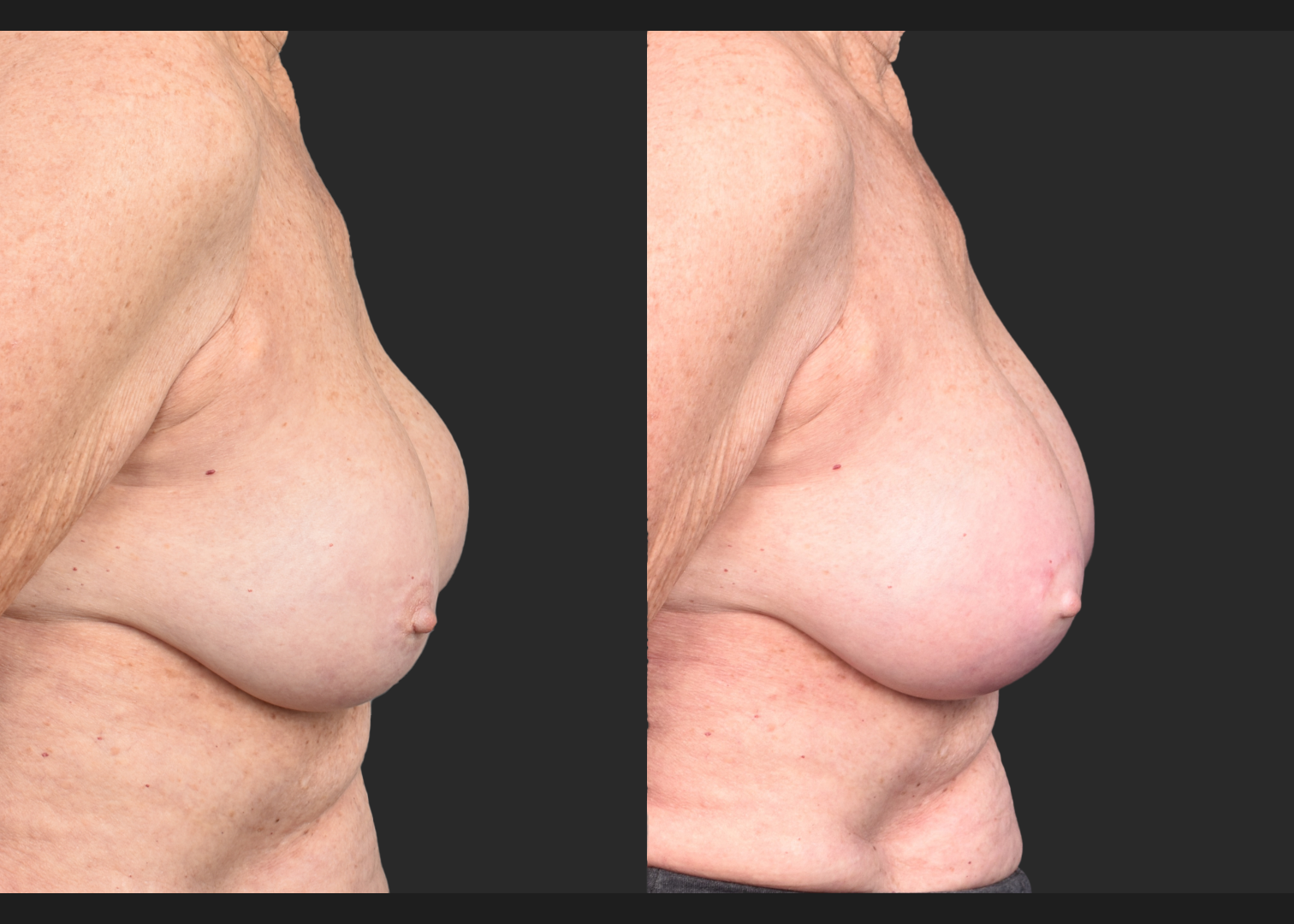 2140594 Breast implant revision exchange capsular contracture capsulectomy before after- right