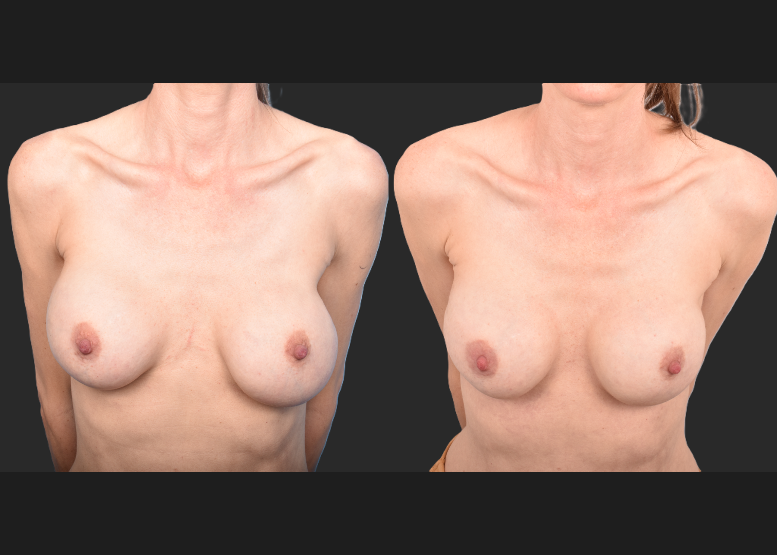 2143129 implant revision saline to silicone exchange natrelle soft touch full profile SSF 325 cc gummy bear pocket correction with internal bra galaflex before after- cleavage