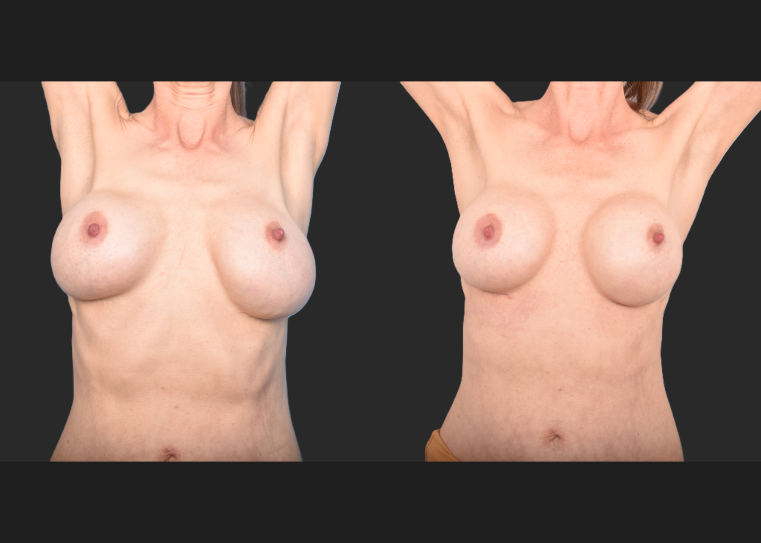 2143129 implant revision saline to silicone exchange natrelle soft touch full profile SSF 325 cc gummy bear pocket correction with internal bra galaflex before after- front up